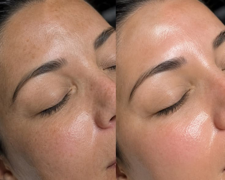 Resultado de Revitalização facial